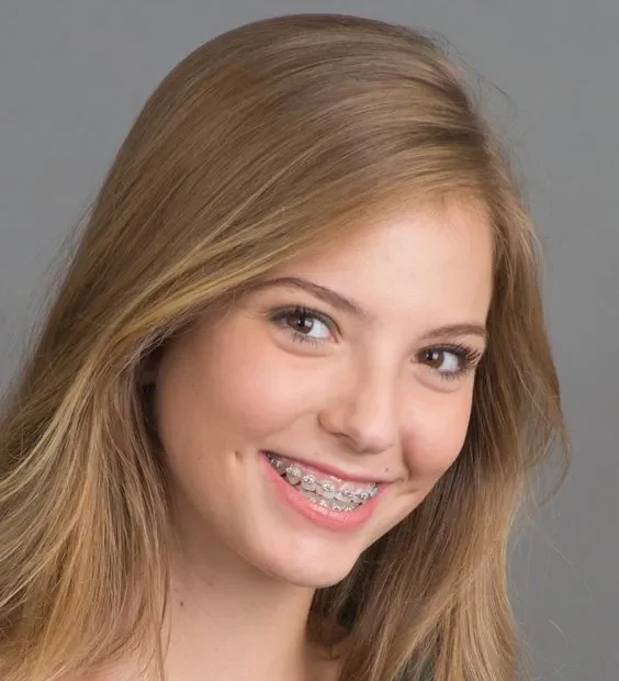 Dental Braces Benefits of Dental Braces