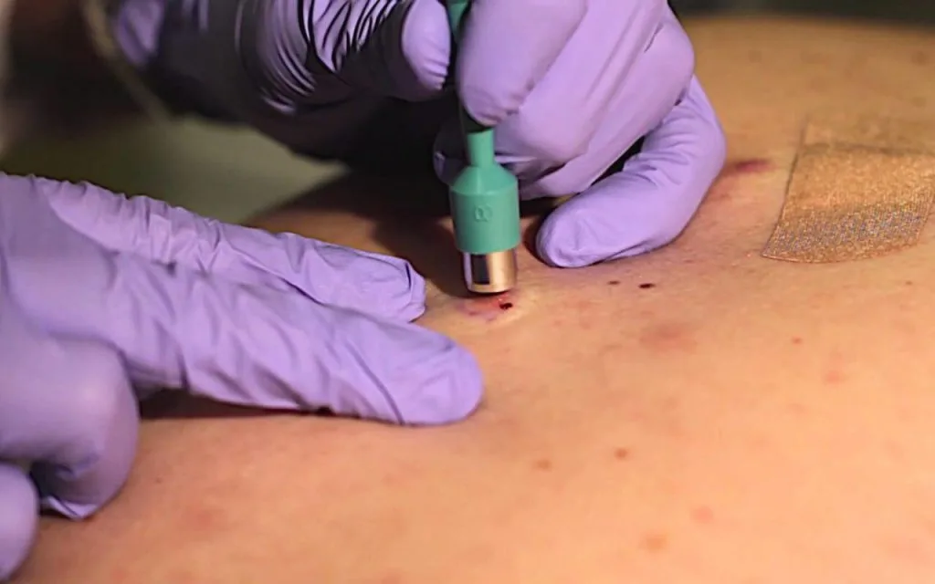 Biopsy & Cancer Management: Biopsy & Cancer therapy