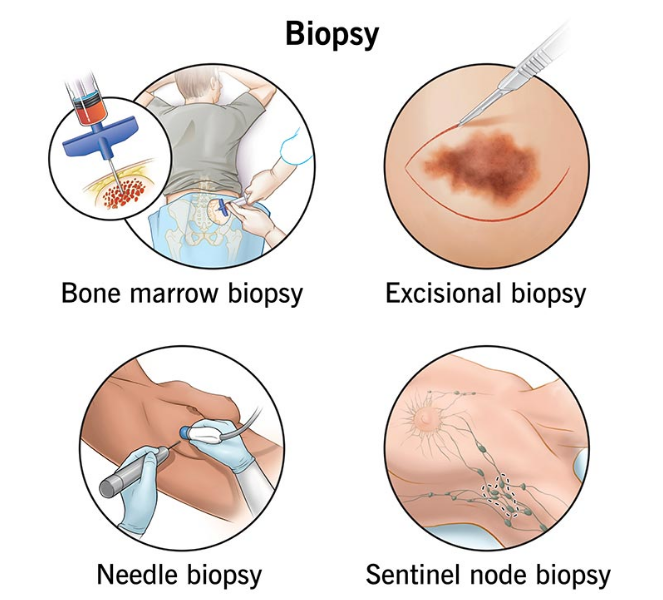 Biopsy And Cancer Management? What Are Biopsy And Cancer Management?