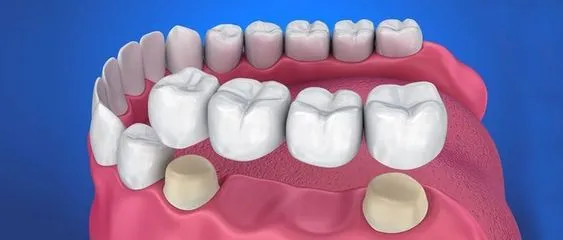 Dental crown & bridge