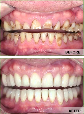 full mouth rehabilitation Benefits of full mouth rehabilitation