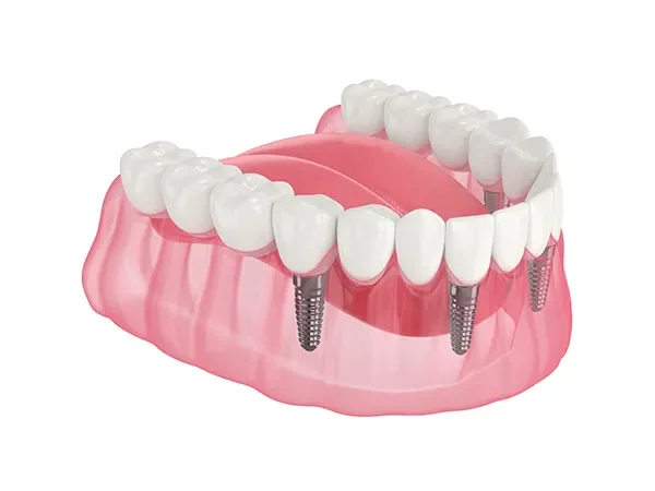 full mouth rehabilitation What exactly is full-mouth rehabilitation?