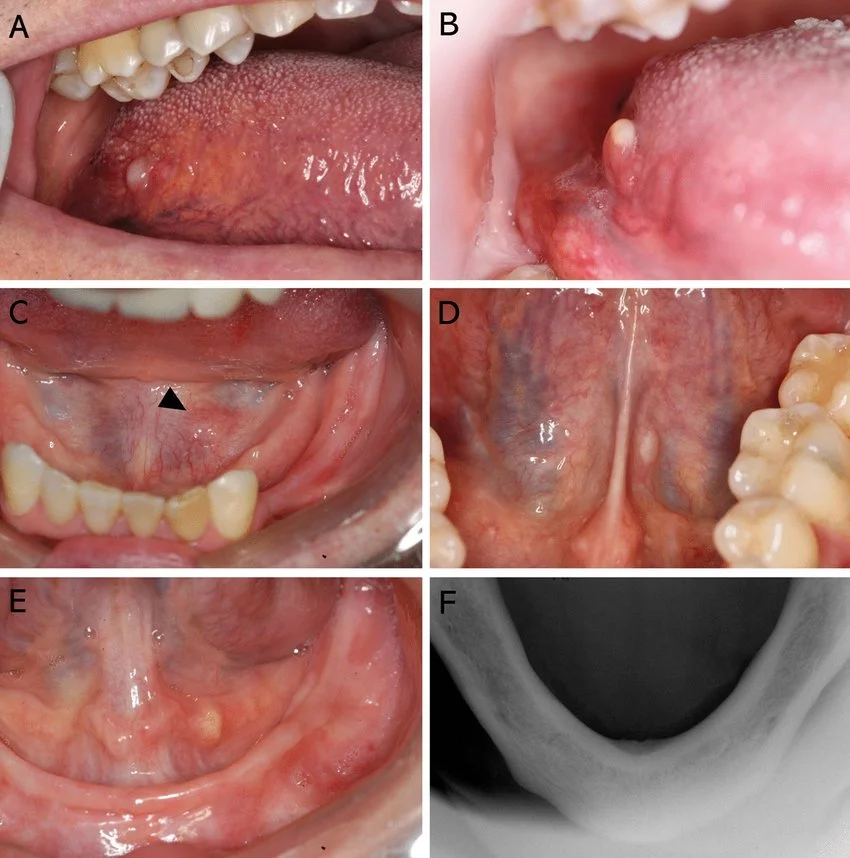 oral & cyst tumor What exactly are Oral & Cyst Tumor