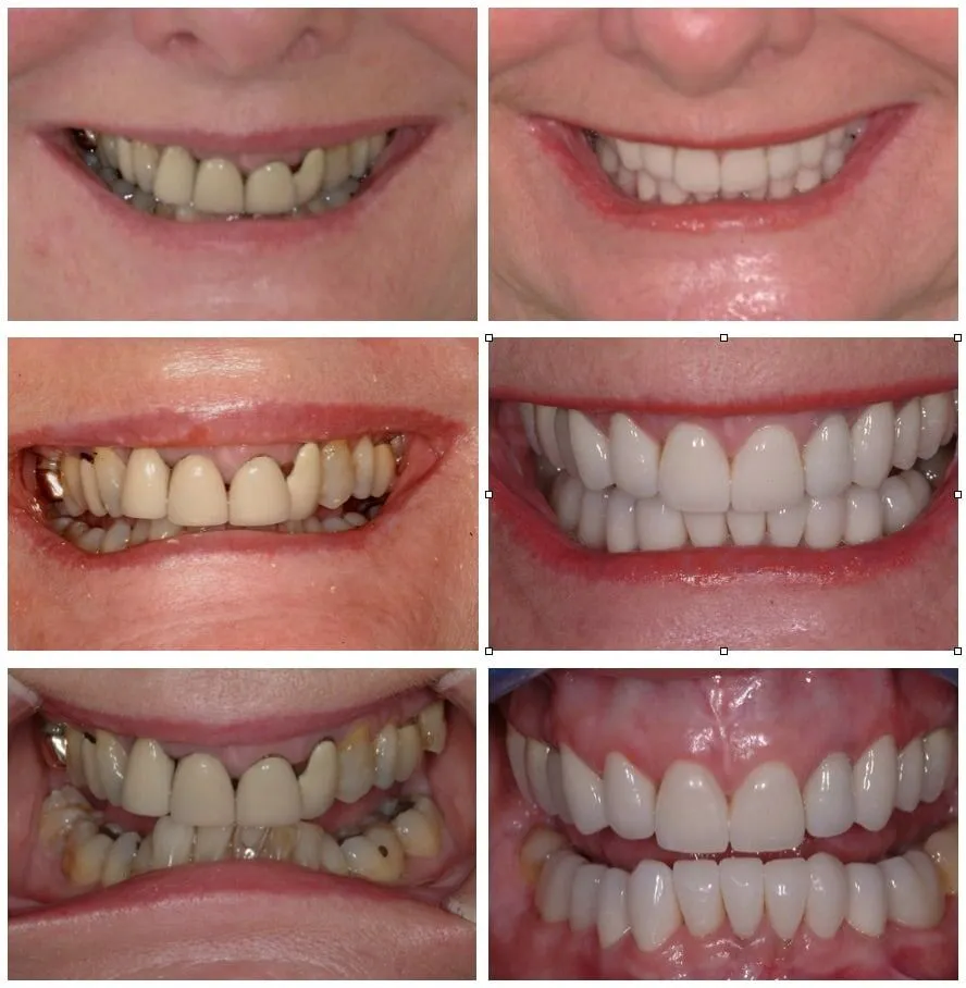 Dental-crown-and-bridge Benefits of Dental crown & bridge