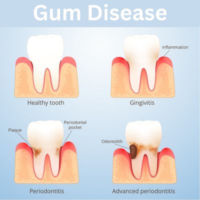 Gum Disease Management