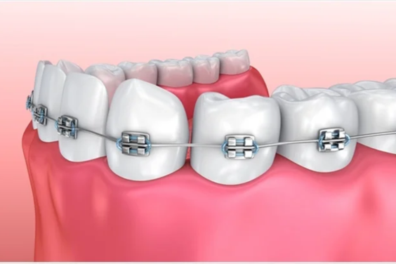 Dental Braces