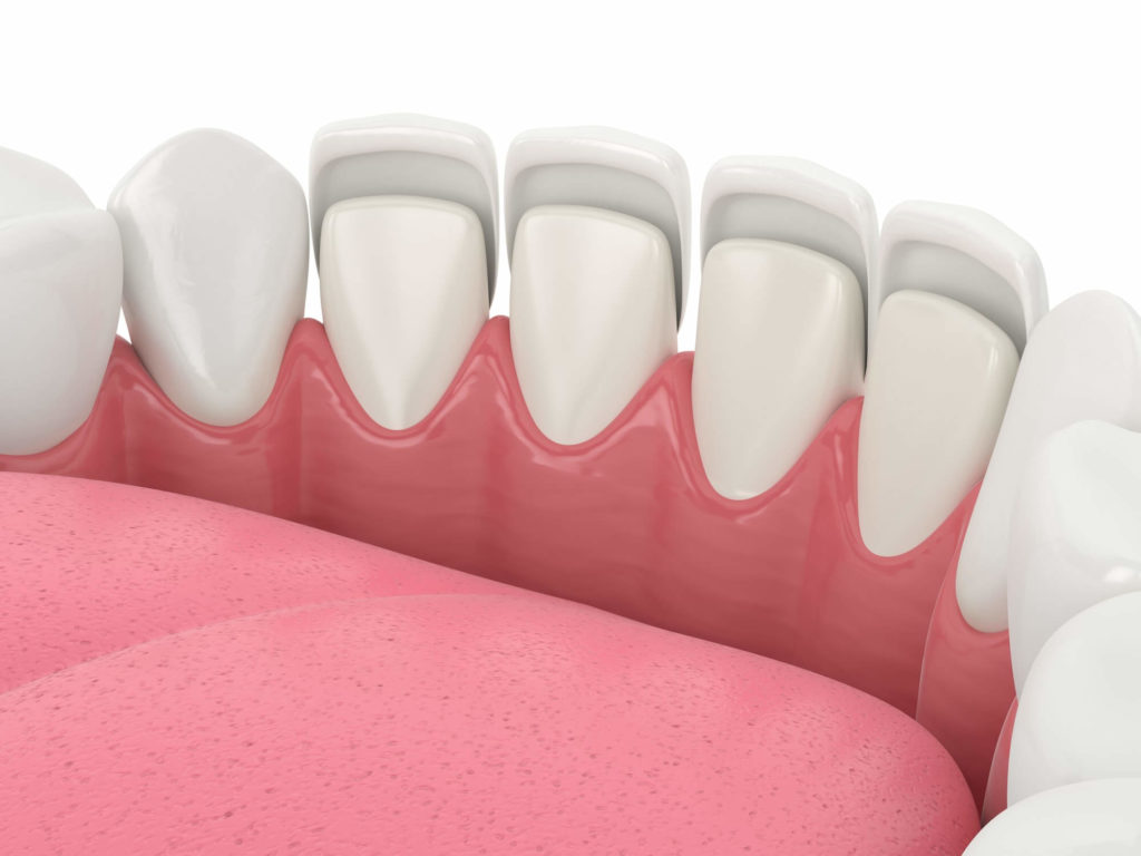 Dental Veneers What Exactly Are Dental Veneers?
