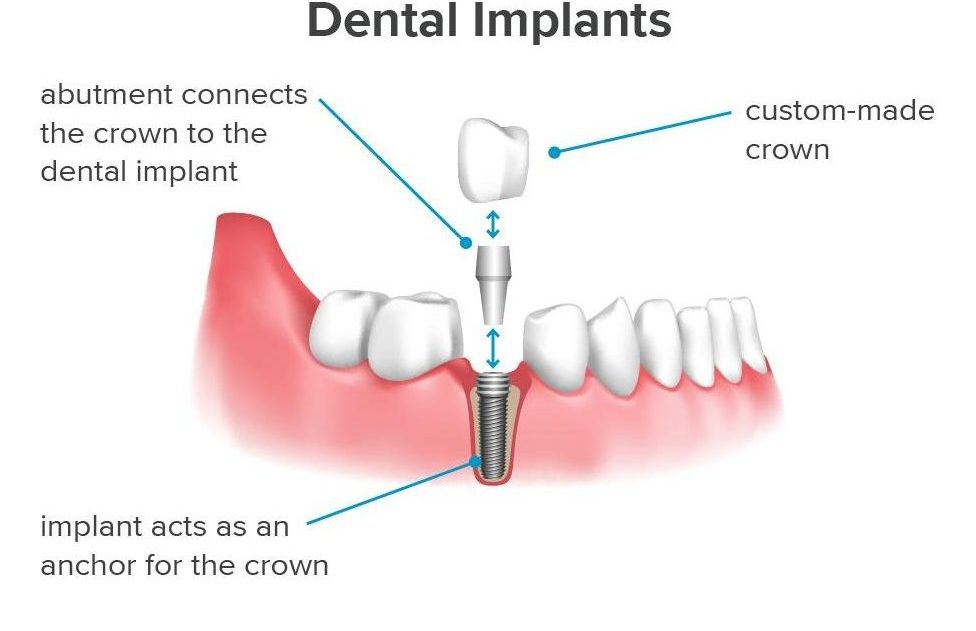 Dental Implant What Exactly Are Dental Implants?