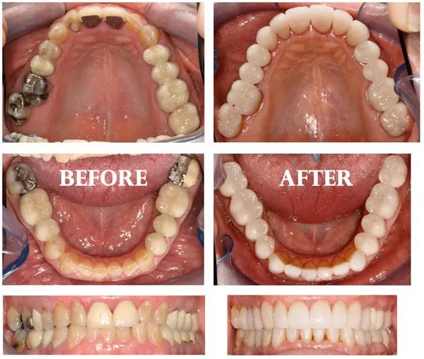 Root Canal Benefits of Root Canal Treatments