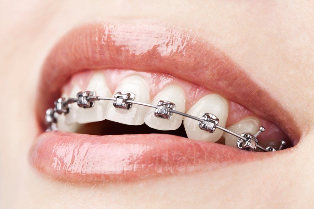 Dental Braces What exactly are dental braces?