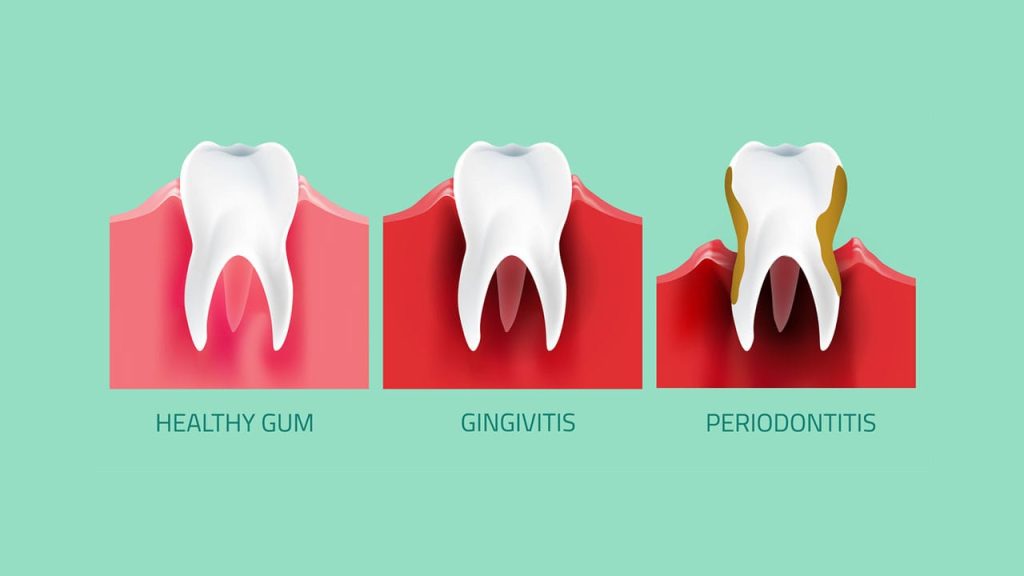 Gum Disease Management What exactly is gum disease?