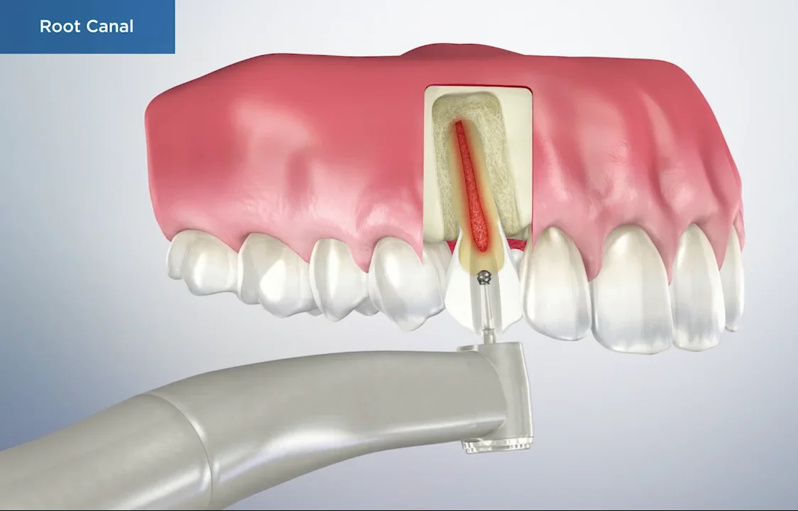 Root Canal What exactly is a root canal treatment?
